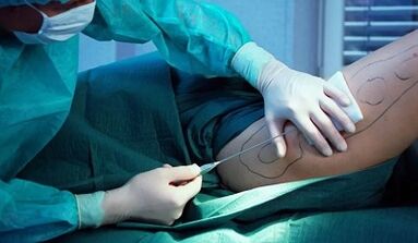 Surgery for weight loss